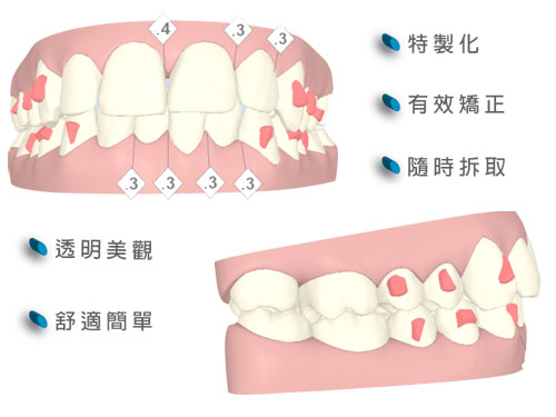 戴隐形牙套可以整形